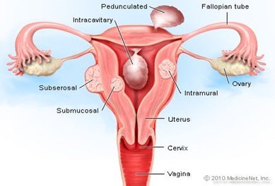 Fibroids on The Uterus